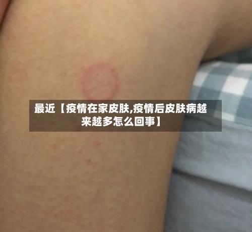 最近【疫情在家皮肤,疫情后皮肤病越来越多怎么回事】-第1张图片